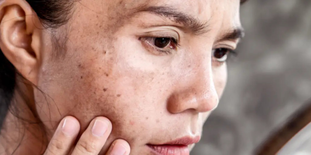 COMO VENCER A LUTA CONTRA AS MANCHAS DE MELASMA 1 Cuidados com a pele com Melasma