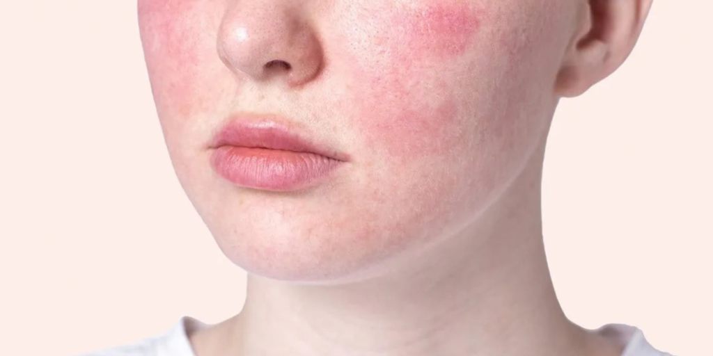 CHEGA DE SOFRER COM A VERMELHIDÃO ROSÁCEA. 1 Pele com Rosacea 1